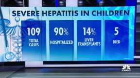 CDC investigates cases of severe hepatitis in children