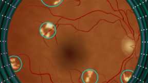 Programas de inteligencia artificial diagnostican retinopatía diabética en minutos